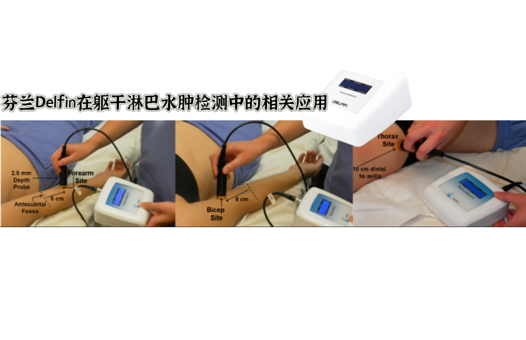 芬蘭Delfin在軀干淋巴水腫檢測中的相關應用